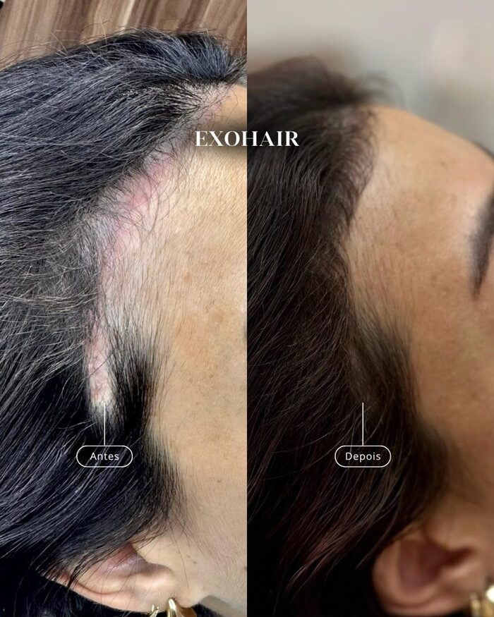 Antes e depois capilar